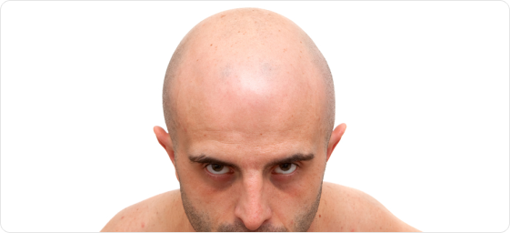Hair transplant for men